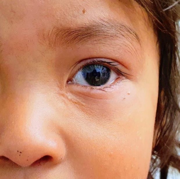 closeup view of young patient's eye after surgery with a tiny tube visible after insertion.